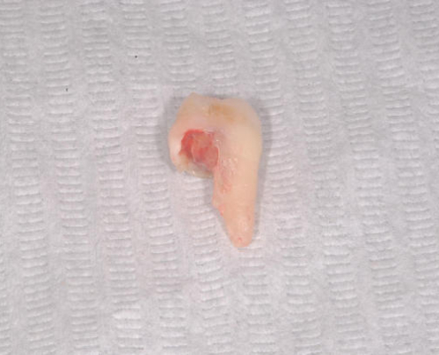 Terceiro molar